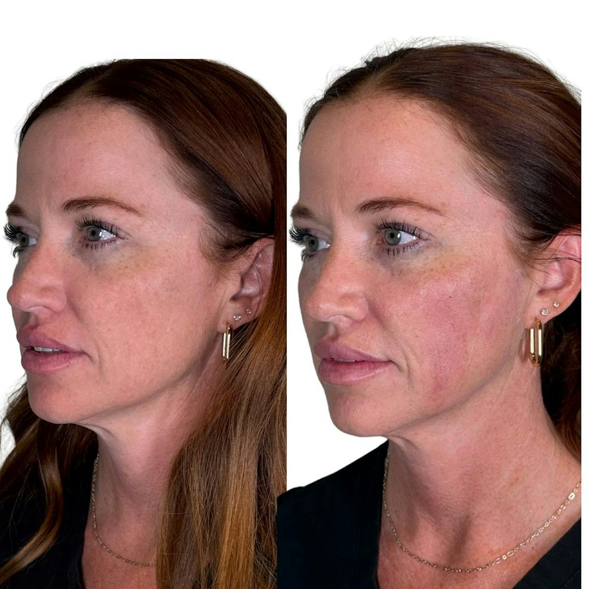 Full Face Filler Before & After Gallery - Patient 121636 - Image 6