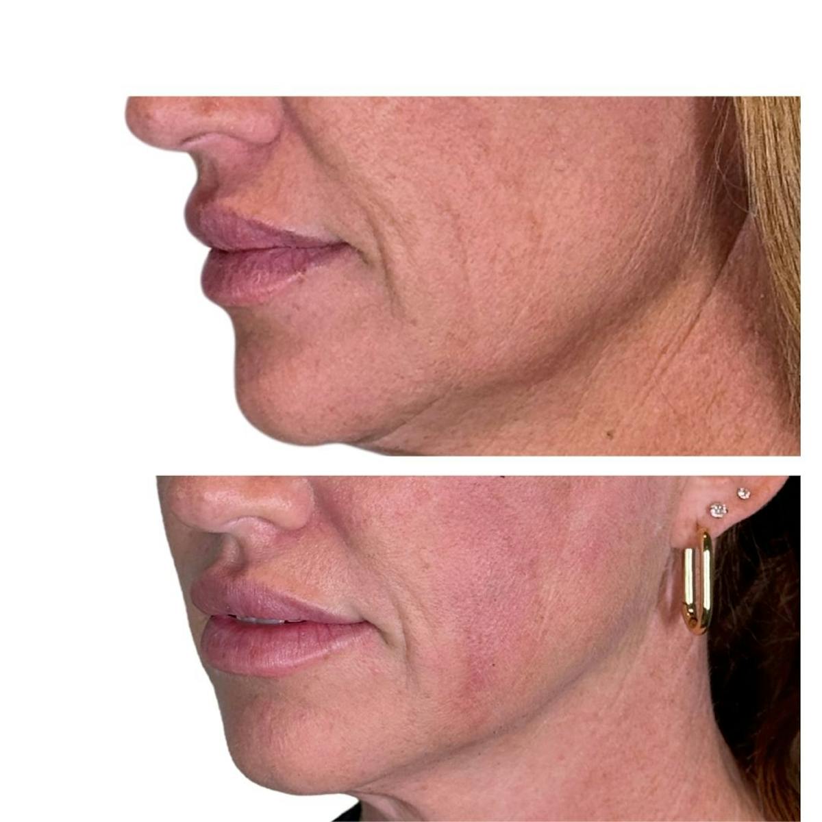 Full Face Filler Before & After Gallery - Patient 121636 - Image 12