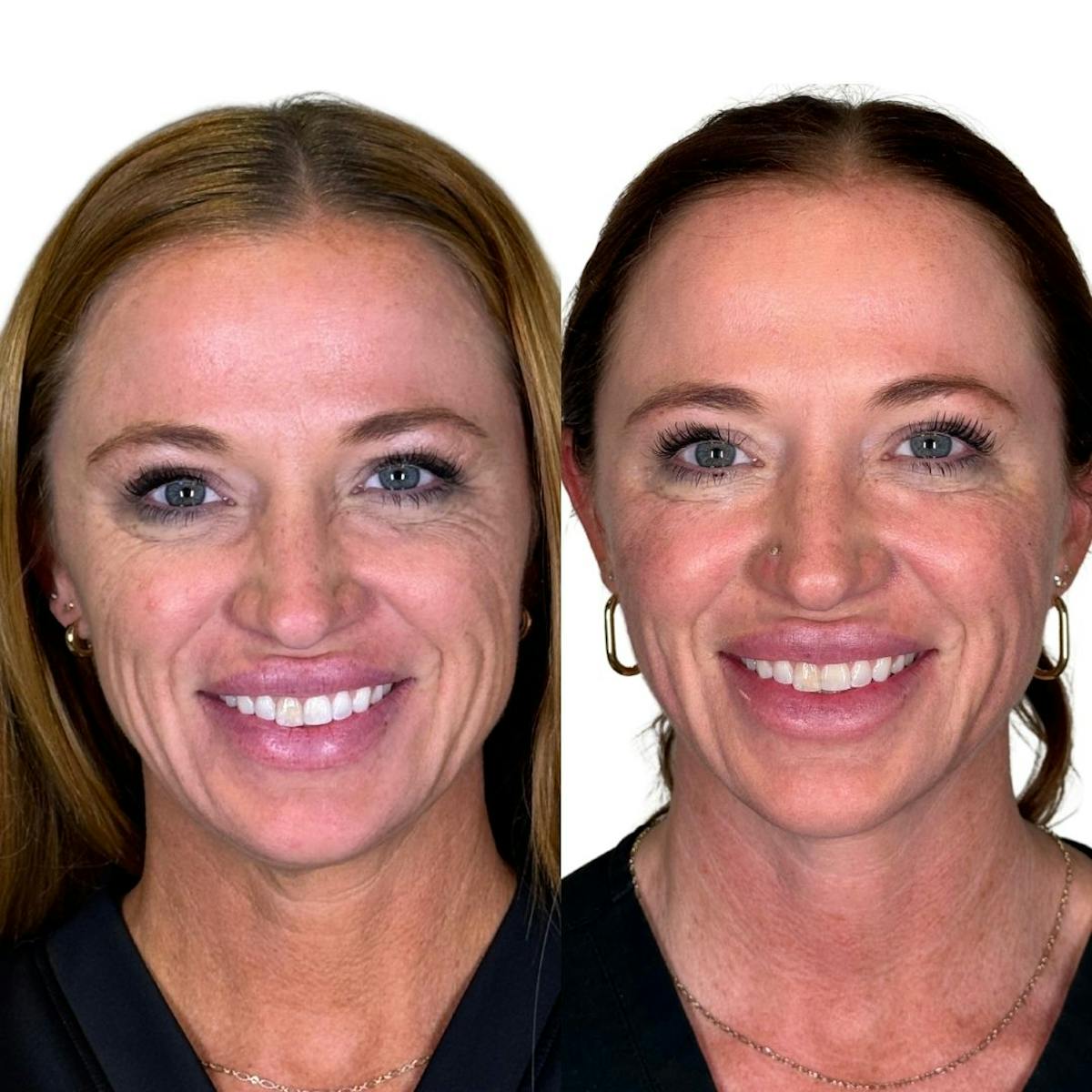 Full Face Filler Before & After Gallery - Patient 121636 - Image 2
