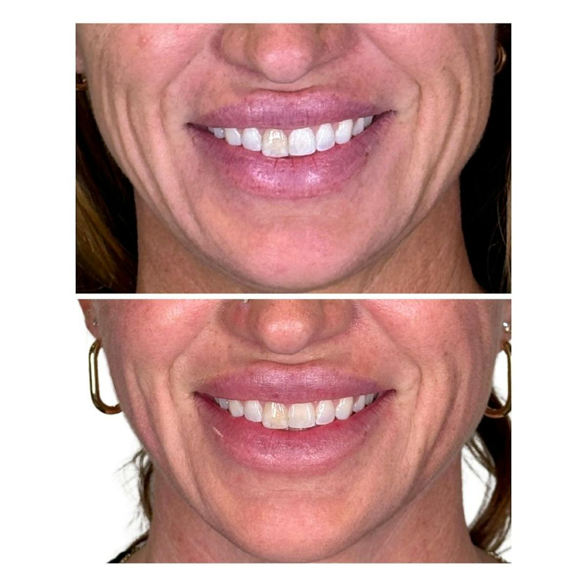Full Face Filler Before & After Gallery - Patient 121636 - Image 8