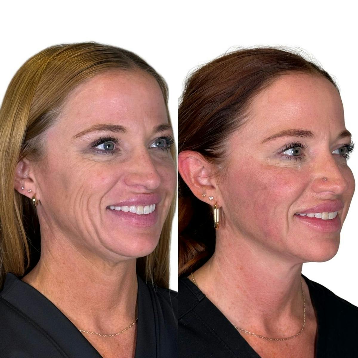 Full Face Filler Before & After Gallery - Patient 121636 - Image 5