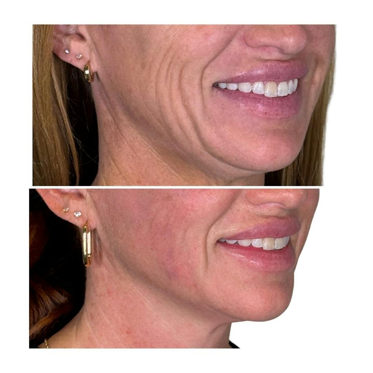 Full Face Filler Before & After Gallery - Patient 121636 - Image 10