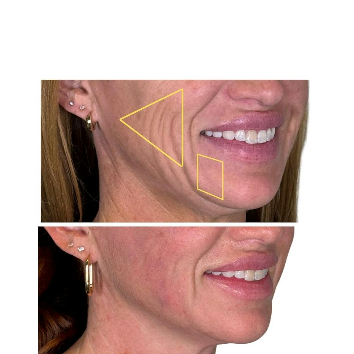 Full Face Filler Before & After Gallery - Patient 121636 - Image 11
