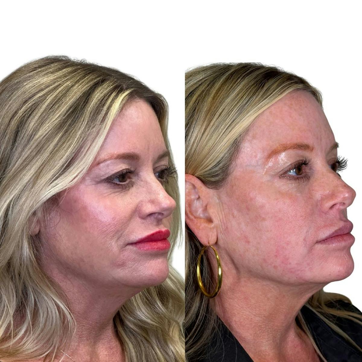 Full Face Filler Before & After Gallery - Patient 134717 - Image 2