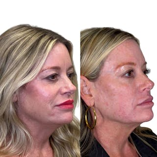 Full Face Filler Before & After Gallery - Patient 134717 - Image 2