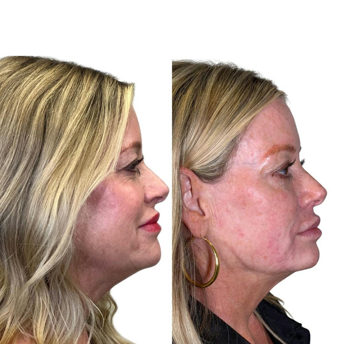 Full Face Filler Before & After Gallery - Patient 134717 - Image 3