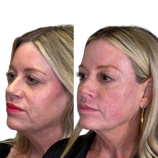 Full Face Filler Before & After Gallery - Patient 134717 - Image 4