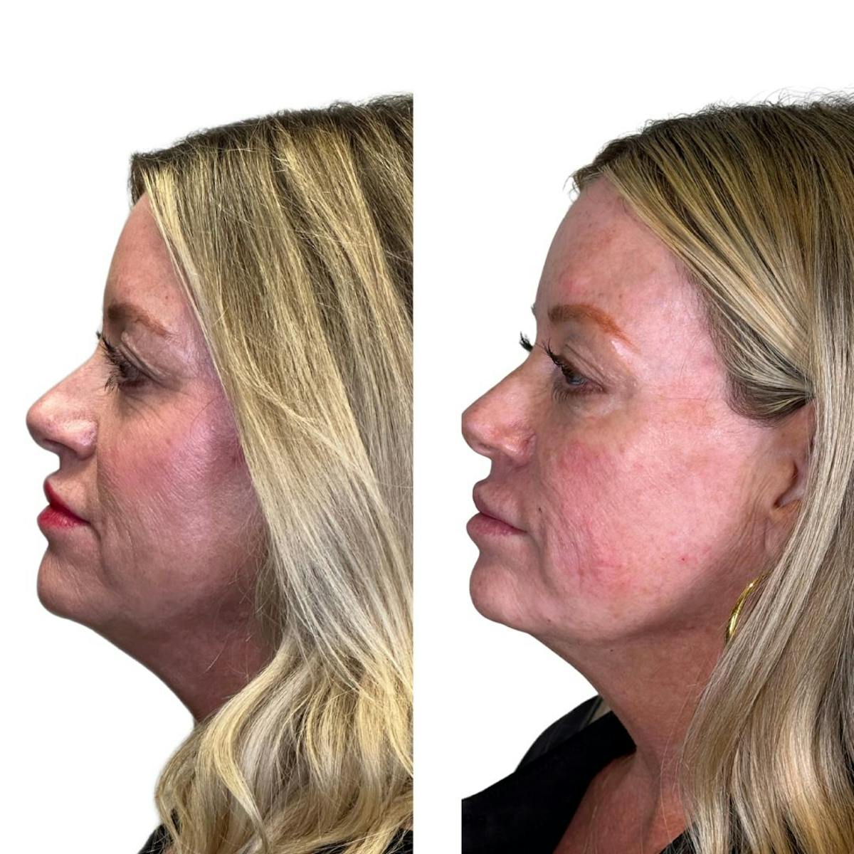 Full Face Filler Before & After Gallery - Patient 134717 - Image 5