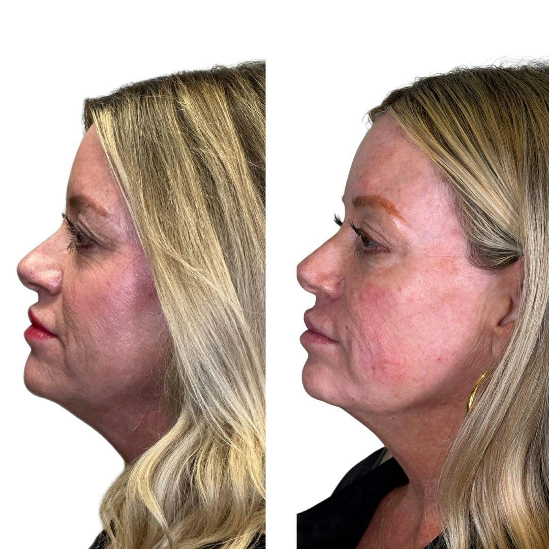 Full Face Filler Before & After Gallery - Patient 134717 - Image 5