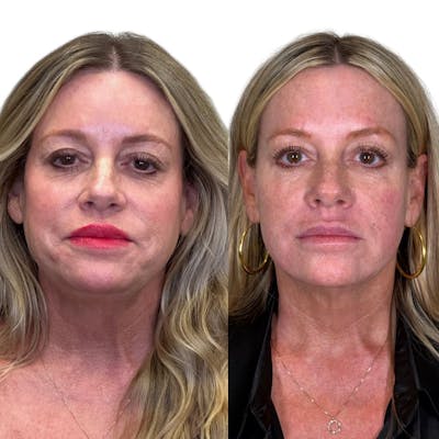 Full Face Filler Before & After Gallery - Patient 134717 - Image 1