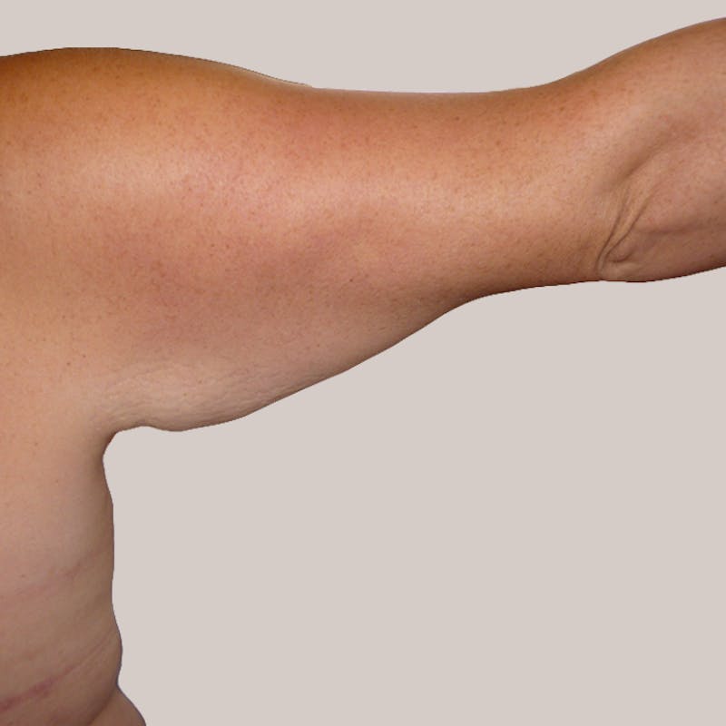 Arm Lift Before & After Gallery - Patient 93812158 - Image 1