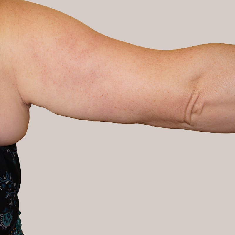 Arm Lift Before & After Gallery - Patient 93812158 - Image 2