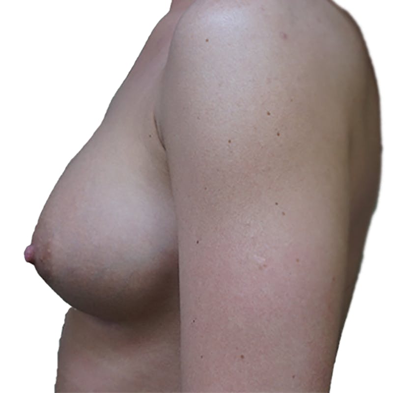 Breast Augmentation Before & After Gallery - Patient 93812191 - Image 2
