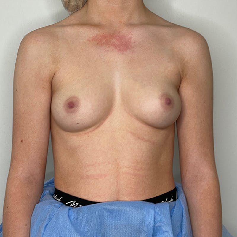 Breast Augmentation Before & After Gallery - Patient 93812192 - Image 1