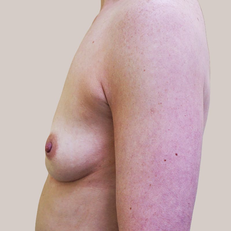 Breast Augmentation Before & After Gallery - Patient 93812193 - Image 1