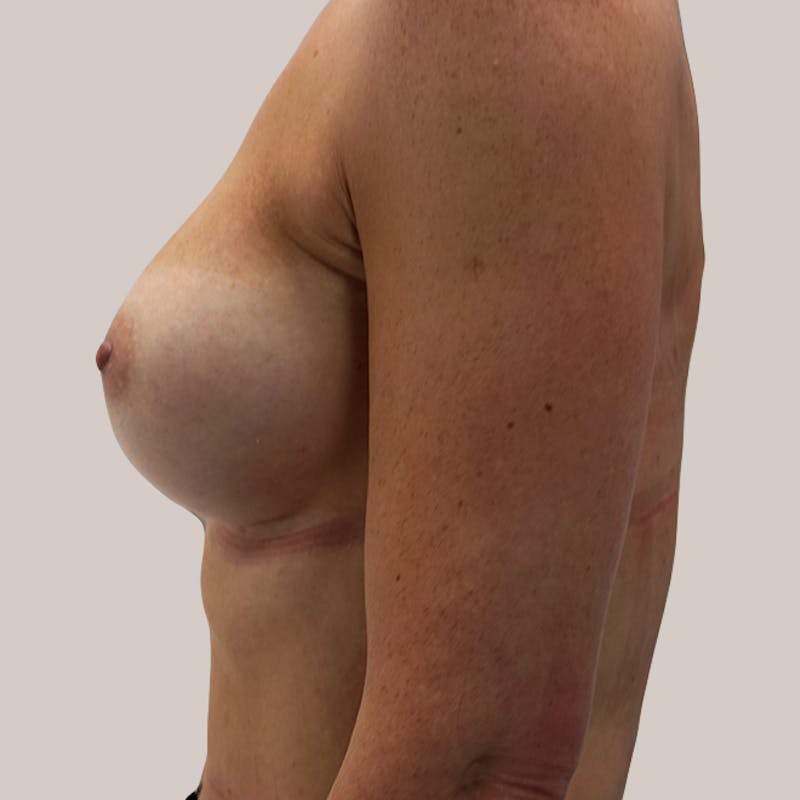 Breast Augmentation Before & After Gallery - Patient 93812193 - Image 2