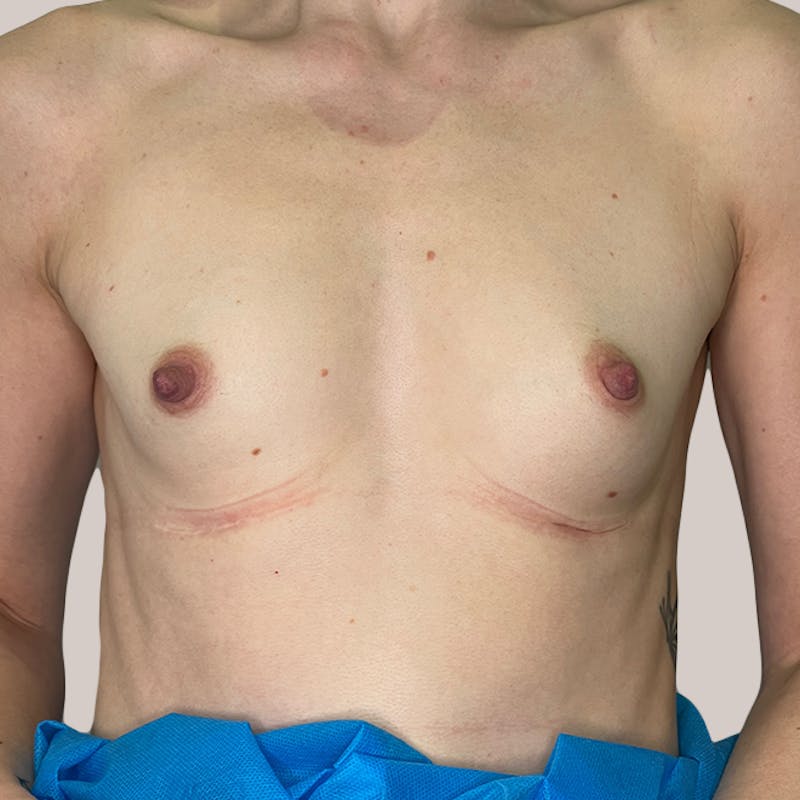 Breast Augmentation Before & After Gallery - Patient 93812194 - Image 1