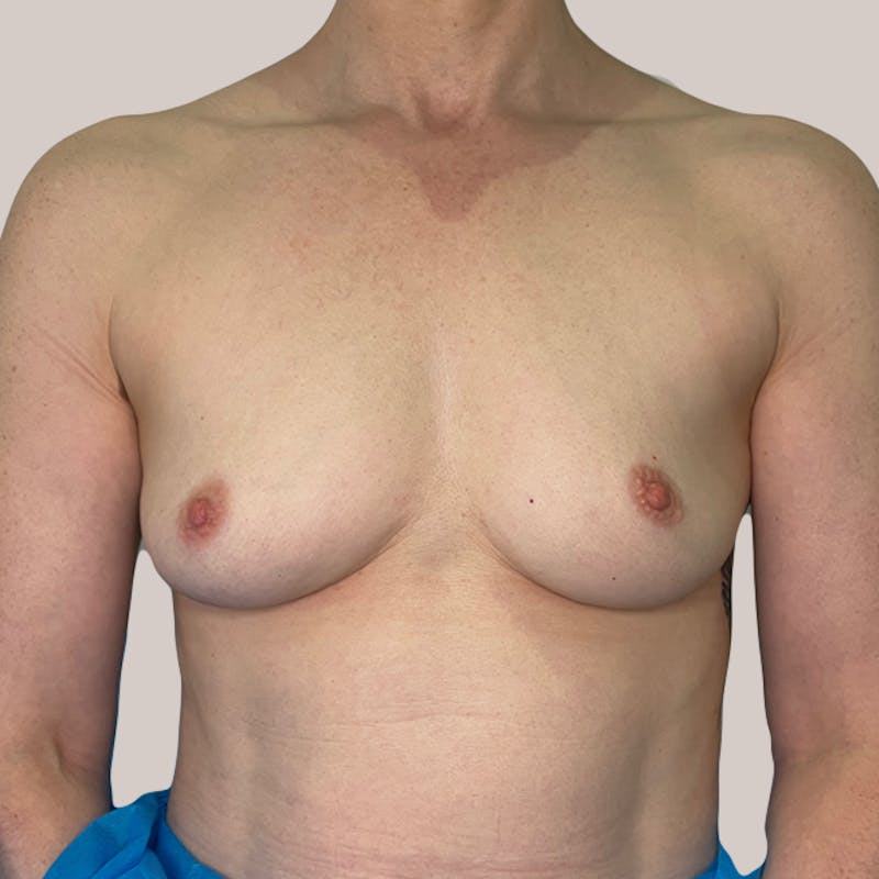 Breast Augmentation Before & After Gallery - Patient 93812209 - Image 1