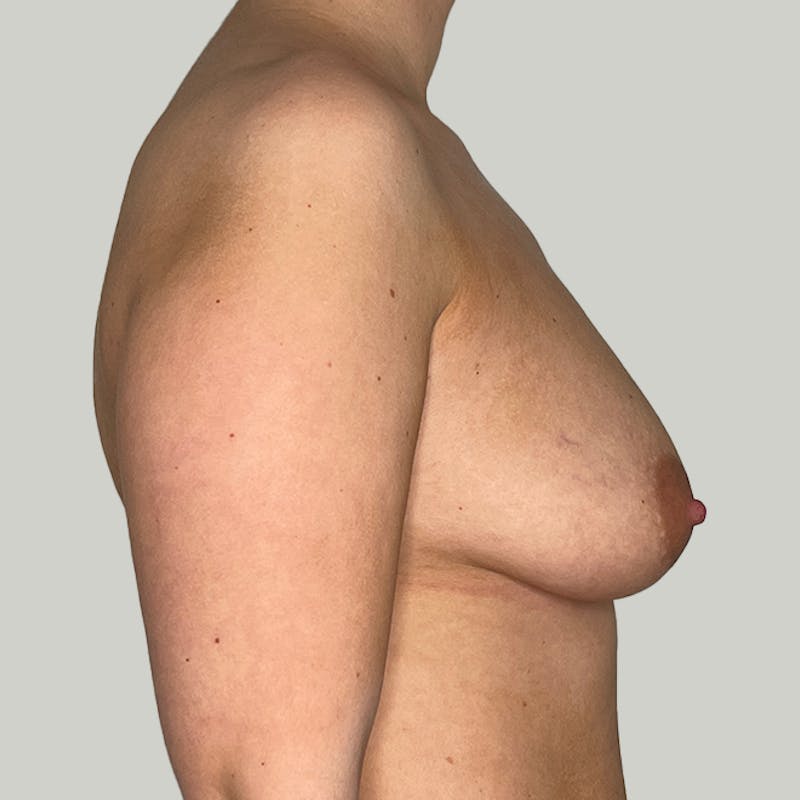 Breast Augmentation Before & After Gallery - Patient 93812211 - Image 1
