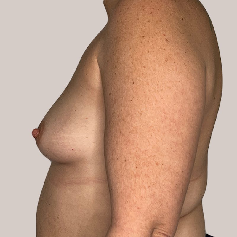 Breast Augmentation Before & After Gallery - Patient 93812212 - Image 1