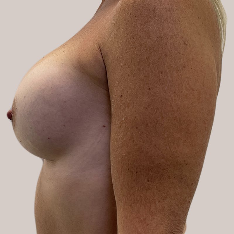 Breast Augmentation Before & After Gallery - Patient 93812212 - Image 2