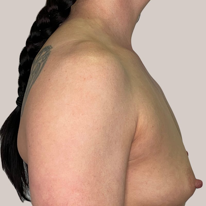 Breast Augmentation Before & After Gallery - Patient 93812213 - Image 1