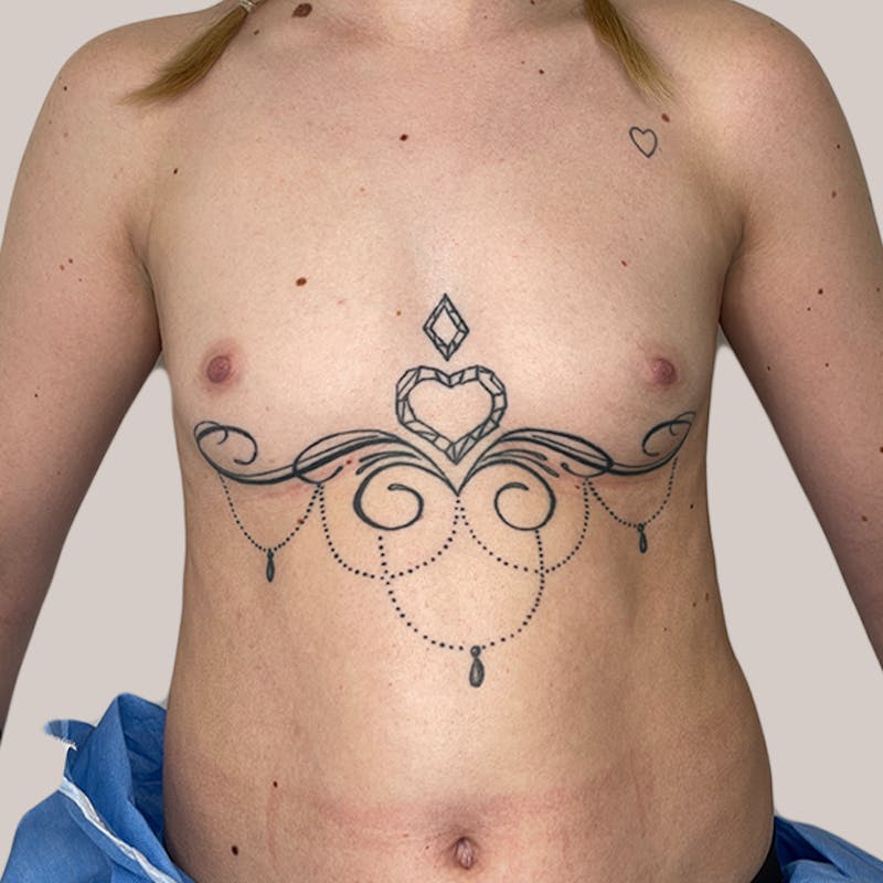 Breast Augmentation Before & After Gallery - Patient 93812214 - Image 1