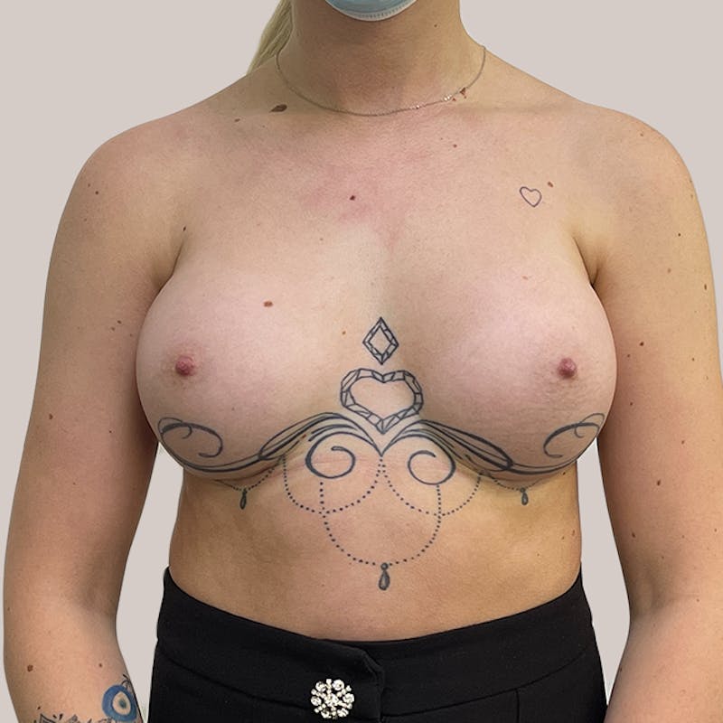 Breast Augmentation Before & After Gallery - Patient 93812214 - Image 2