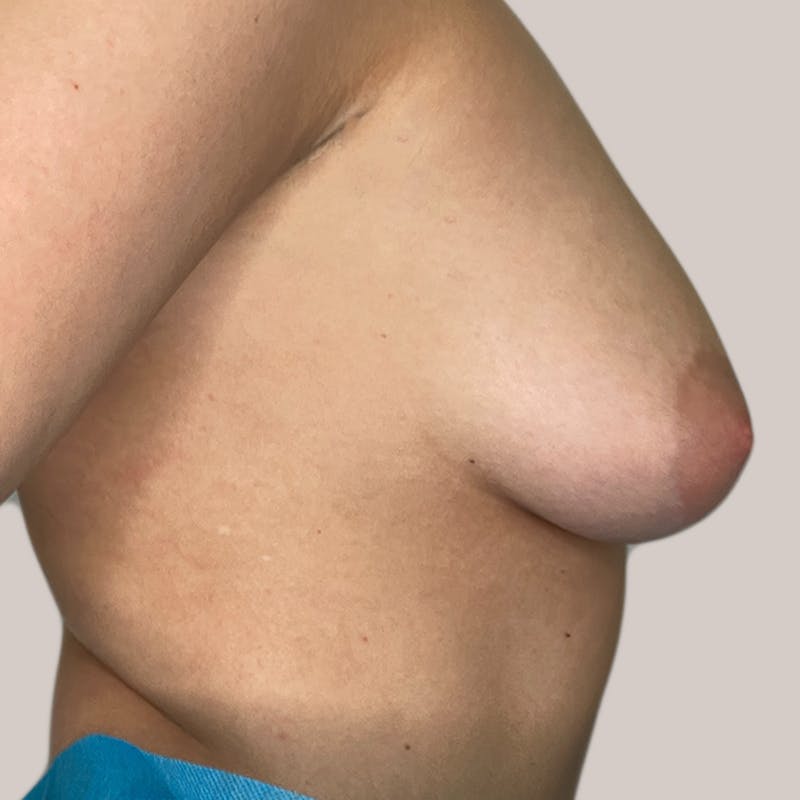 Breast Augmentation Before & After Gallery - Patient 93812215 - Image 1