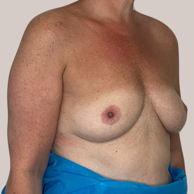 Breast Augmentation Before & After Gallery - Patient 93812216 - Image 1