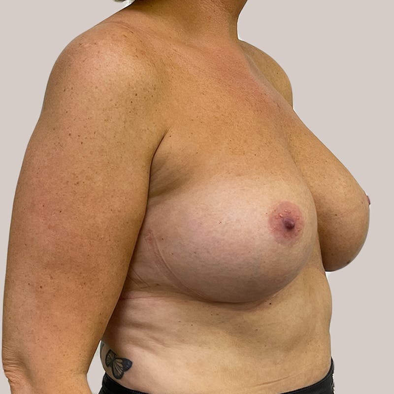 Breast Augmentation Before & After Gallery - Patient 93812216 - Image 2