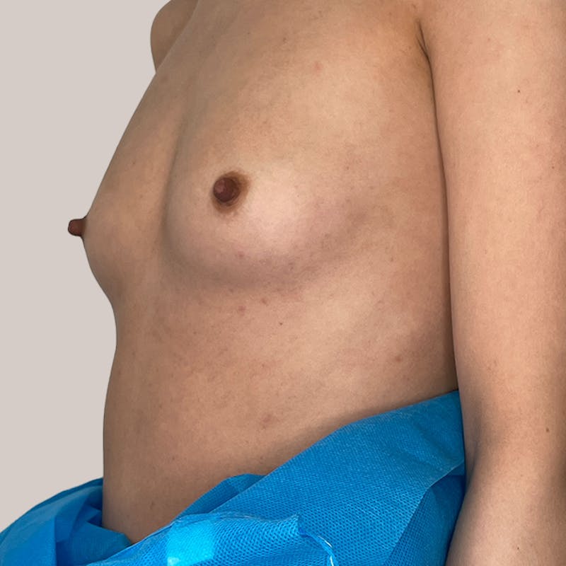 Breast Augmentation Before & After Gallery - Patient 93812217 - Image 1