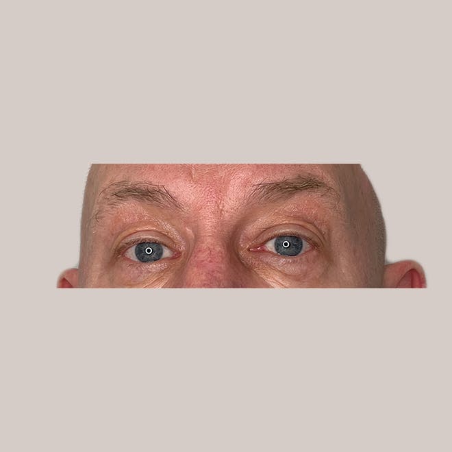 Eyelid Surgery