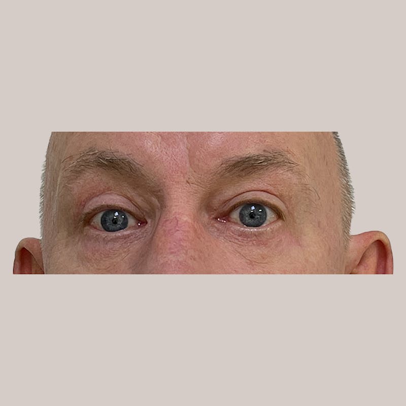 Eyelid Surgery Before & After Gallery - Patient 93812344 - Image 2