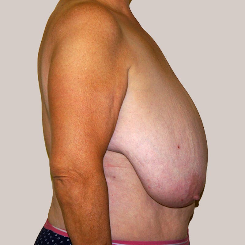 Breast Reduction  Before & After Gallery - Patient 93812248 - Image 1