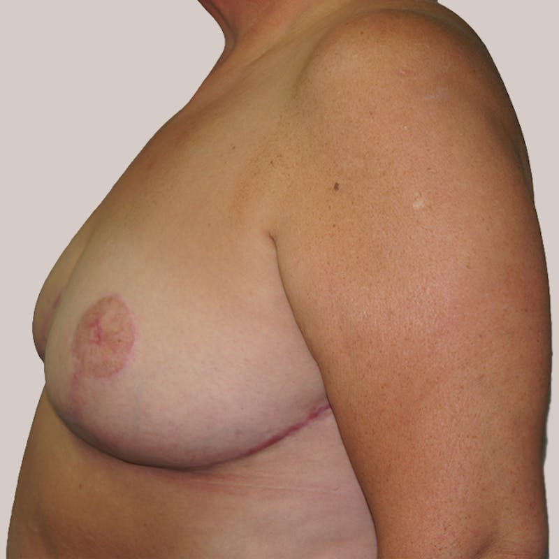 Breast Reduction  Before & After Gallery - Patient 93812248 - Image 2