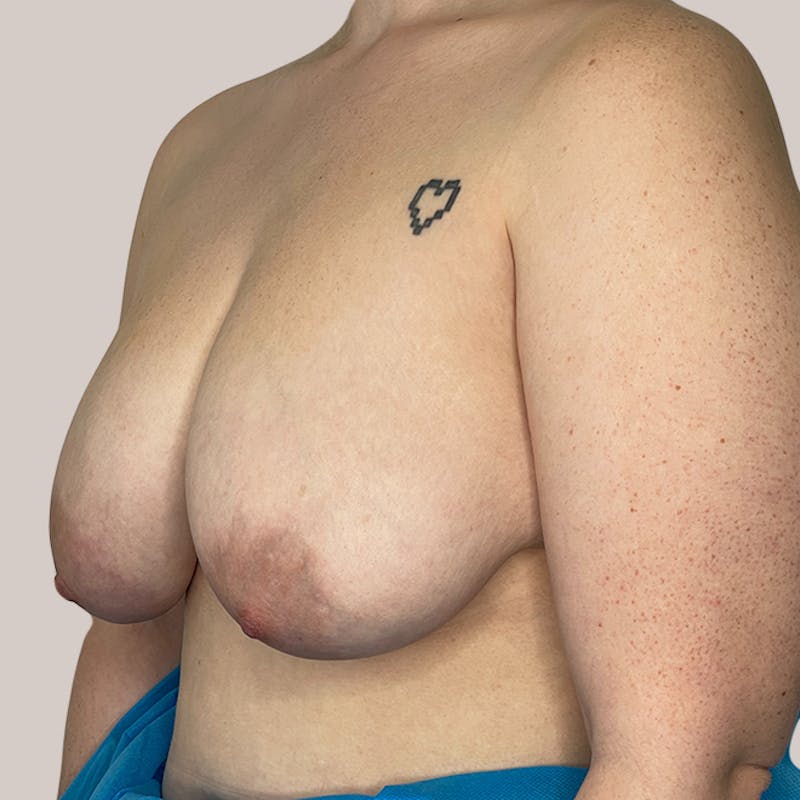 Breast Reduction  Before & After Gallery - Patient 93812249 - Image 1