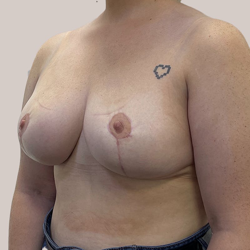 Breast Reduction  Before & After Gallery - Patient 93812249 - Image 2