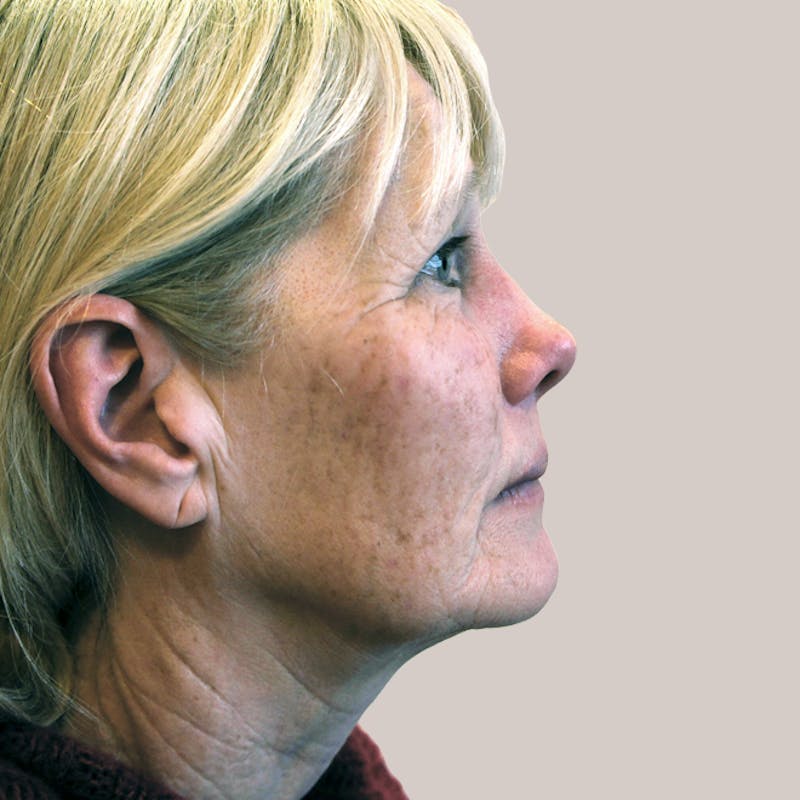 Facelift Before & After Gallery - Patient 93812346 - Image 1