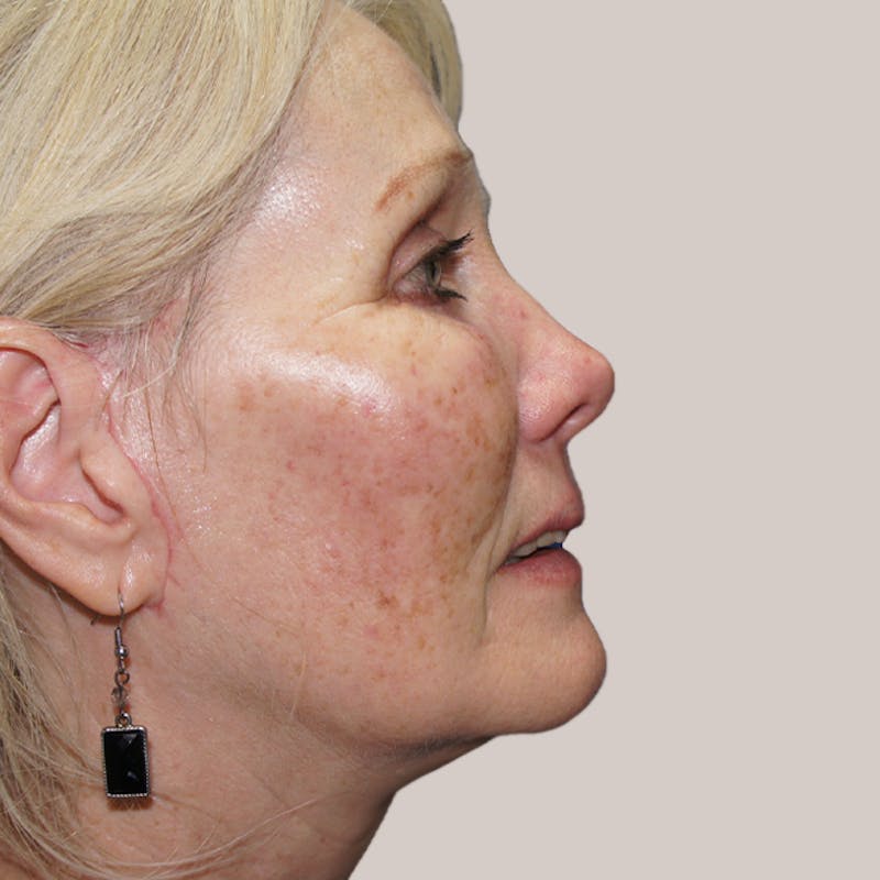 Facelift Before & After Gallery - Patient 93812346 - Image 2