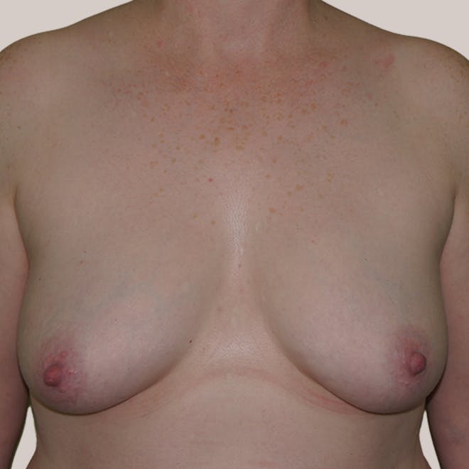 Fat Transfer Breast Augmentation