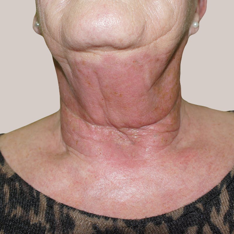 Laser Resurfacing Before & After Gallery - Patient 93812366 - Image 1