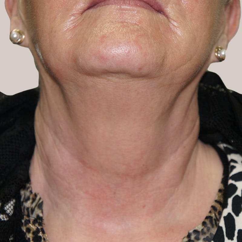 Laser Resurfacing Before & After Gallery - Patient 93812366 - Image 2