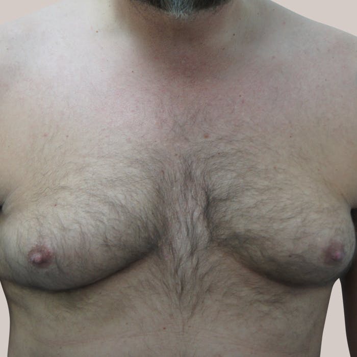 Male Breast Reduction