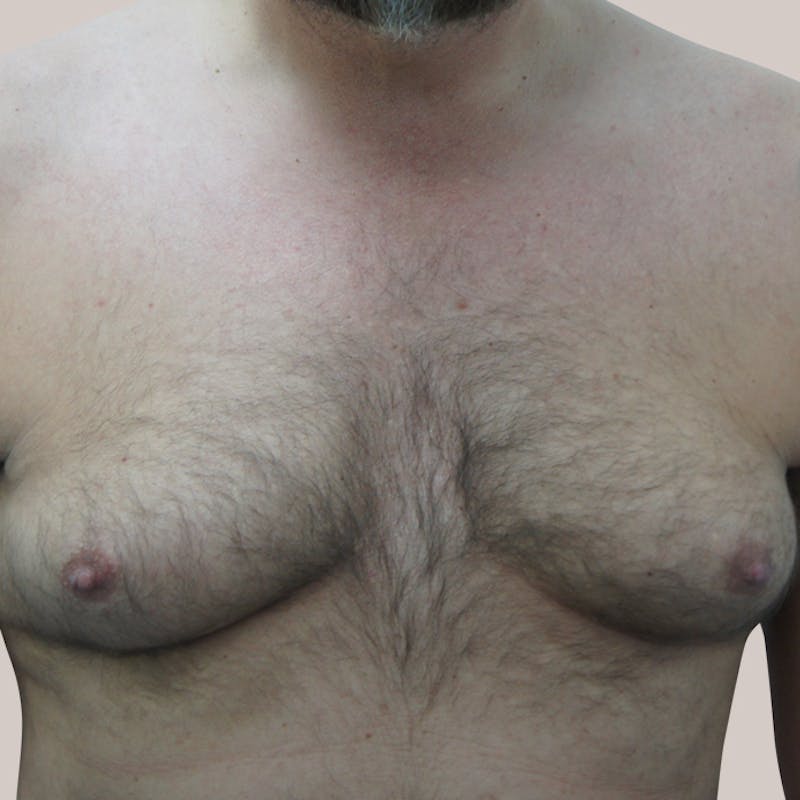 Gynecomastia (Male Breast Reduction) Before & After Gallery - Patient 93812392 - Image 1