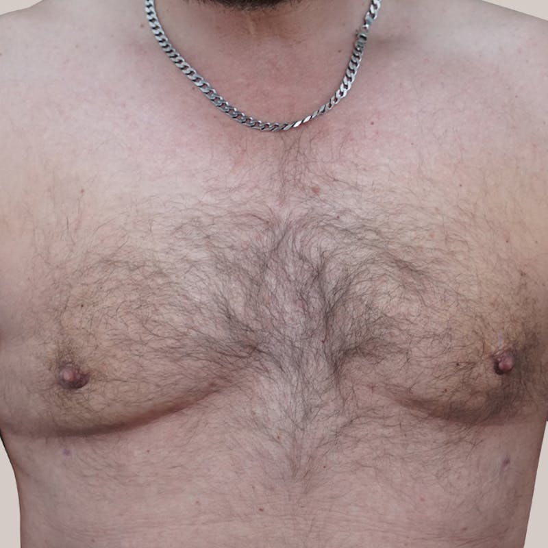 Gynecomastia (Male Breast Reduction) Before & After Gallery - Patient 93812392 - Image 2