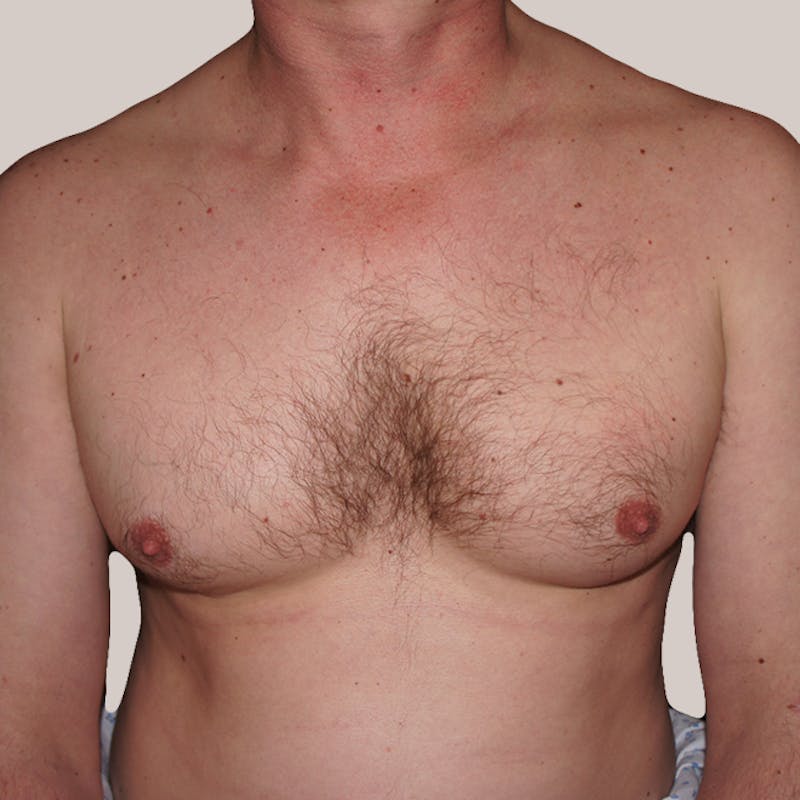 Gynecomastia (Male Breast Reduction) Before & After Gallery - Patient 93812393 - Image 1