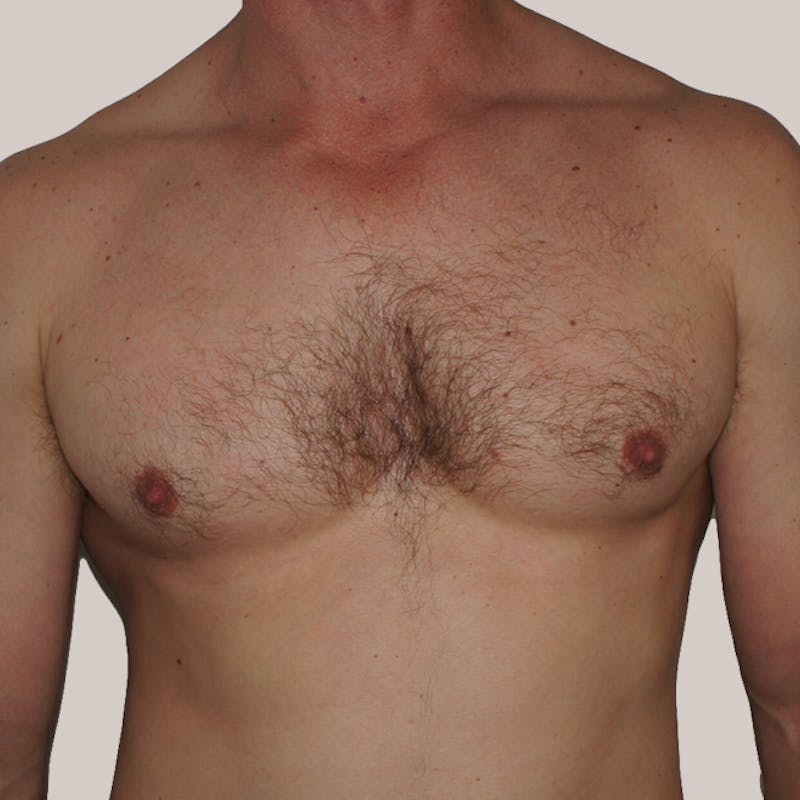 Gynecomastia (Male Breast Reduction) Before & After Gallery - Patient 93812393 - Image 2