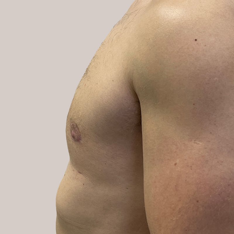 Gynecomastia (Male Breast Reduction) Before & After Gallery - Patient 93812394 - Image 2