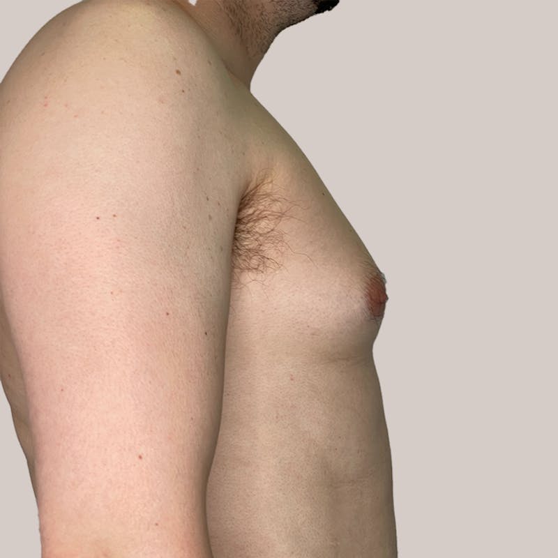 Gynecomastia (Male Breast Reduction) Before & After Gallery - Patient 93812395 - Image 1